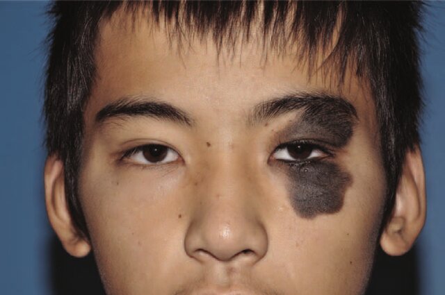 Divided Nevus