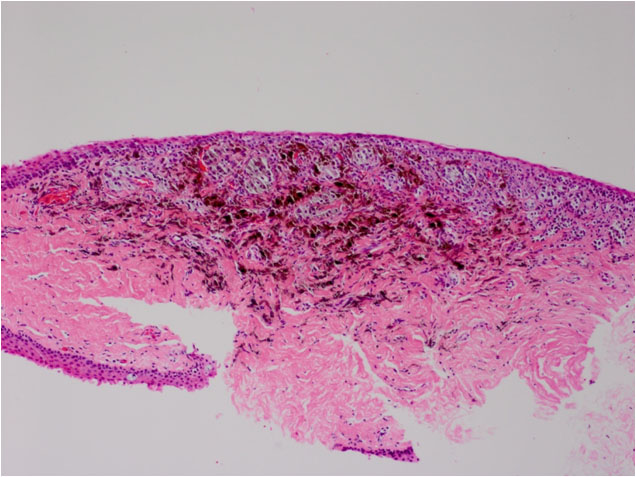 File:Fig. 1B - conj combined nevus path 1.jpg