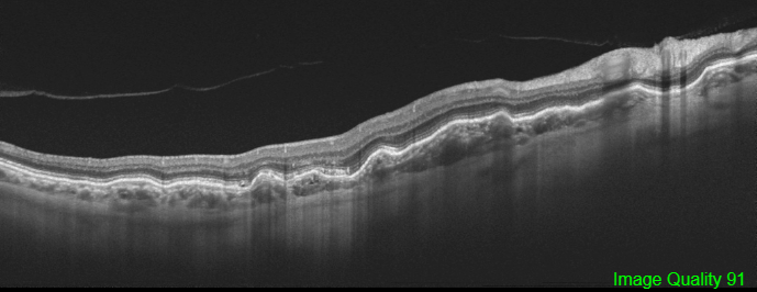 File:Choroidal Folds OCT.png