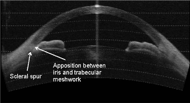 File:Primary Angle Closure Using OCT in Asians.jpg