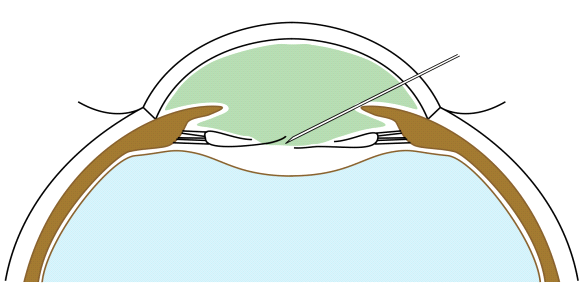 File:Puncture of the posterior capsule.png