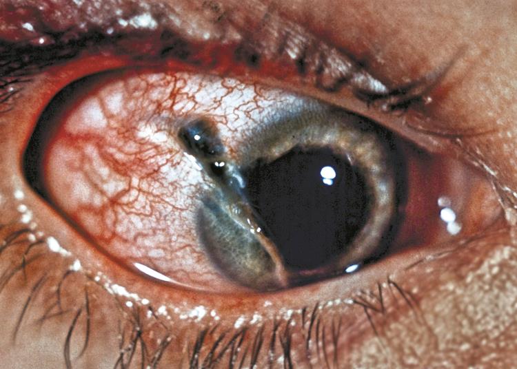 File:Penetrating Trauma.jpg