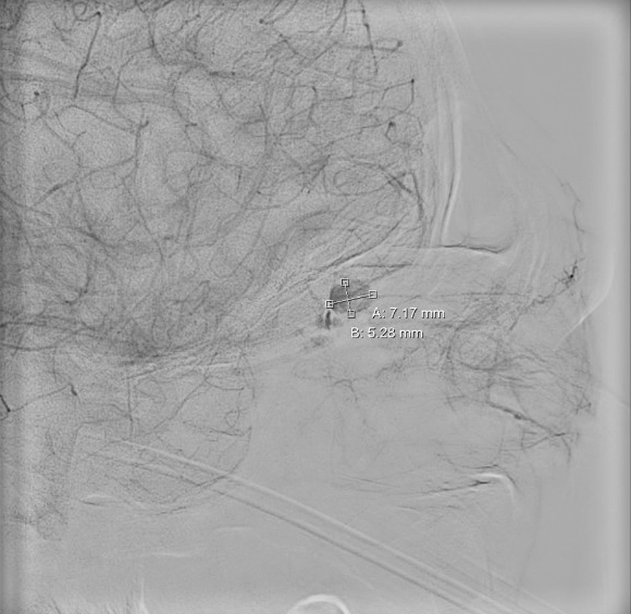 File:Angiogram OAPA.png