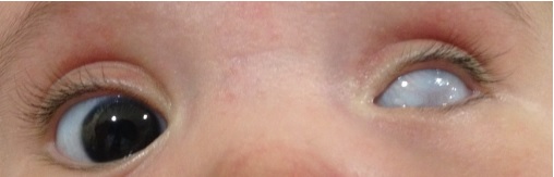 File:Sclerocornea total with microphthalmus in left eye.jpg