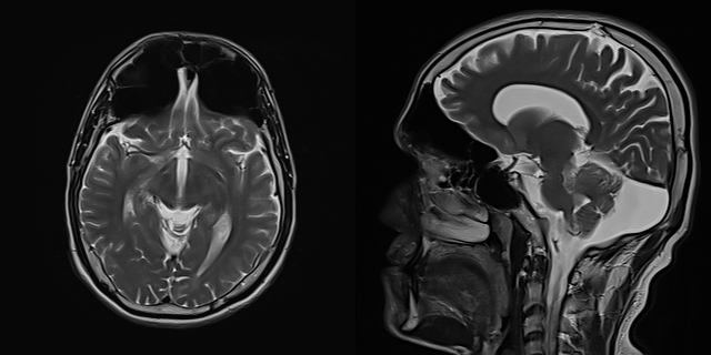 File:Pneumosinus dilatans bilateral frontal sinuses.jpg