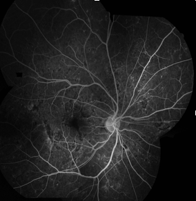 File:FA in a patient with HELLP syndrome.png