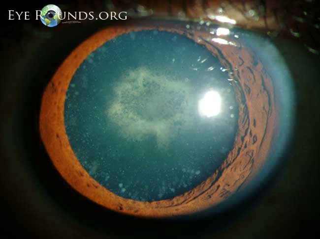 File:Cerulean cataract 2.jpg