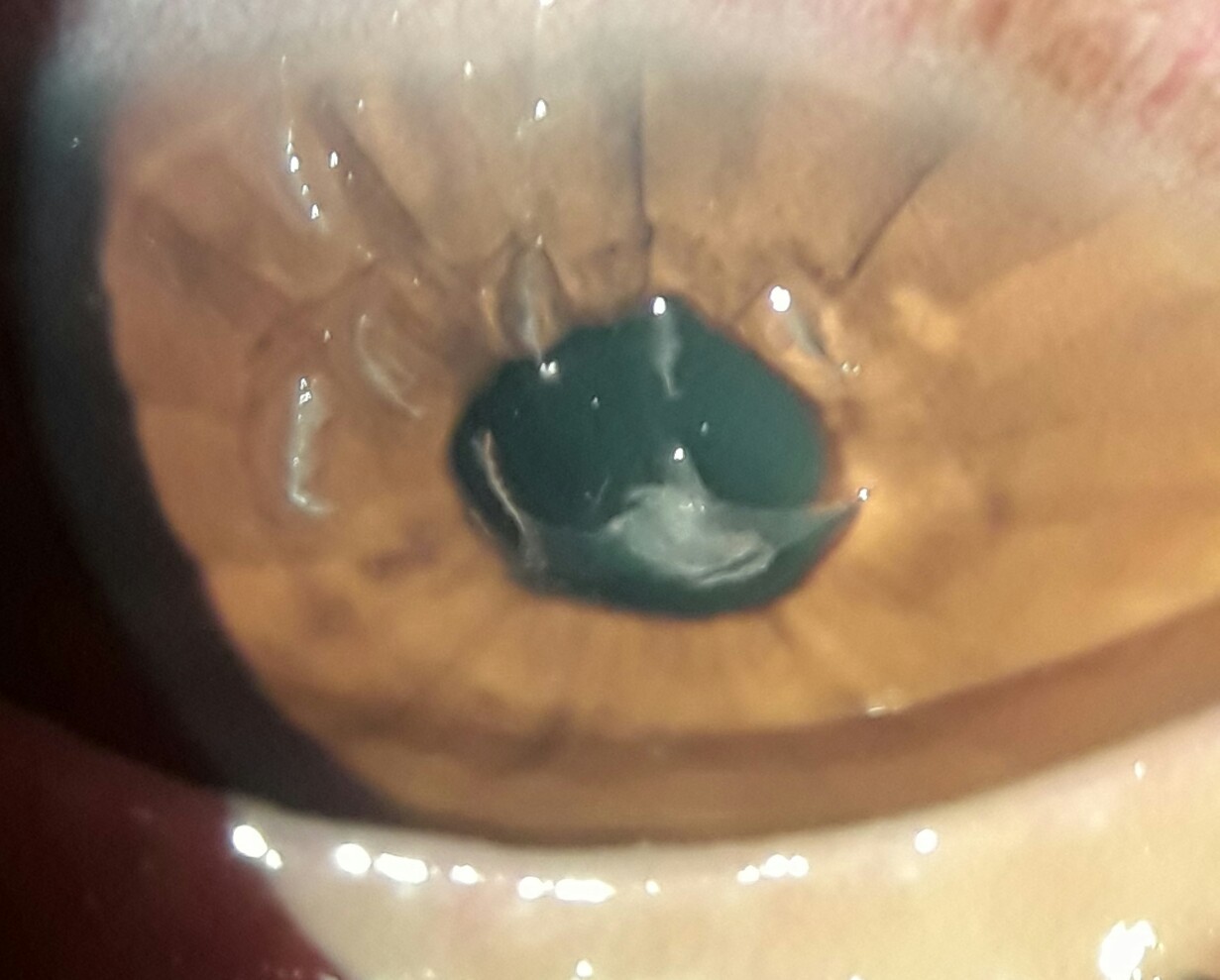 Filamentary Keratitis