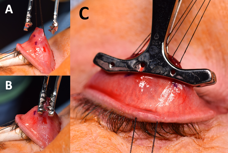 File:MMCR Eyewiki Figure 6.png