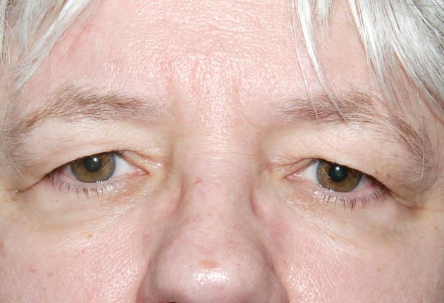 File:Dermatochalasis4.jpg