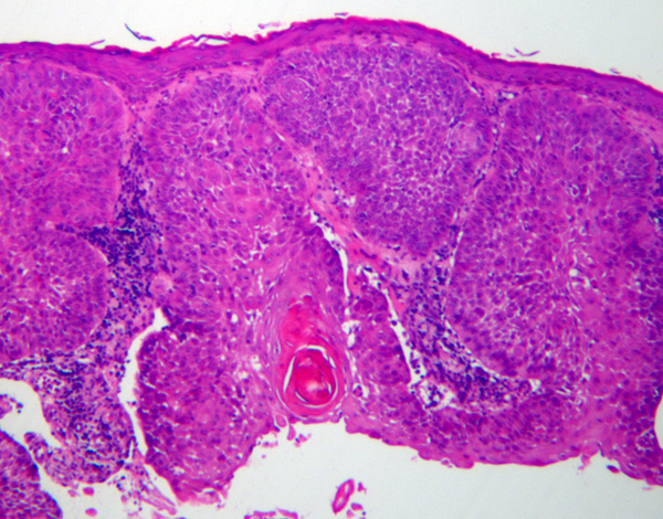 File:SCCA low magnifcation.jpg