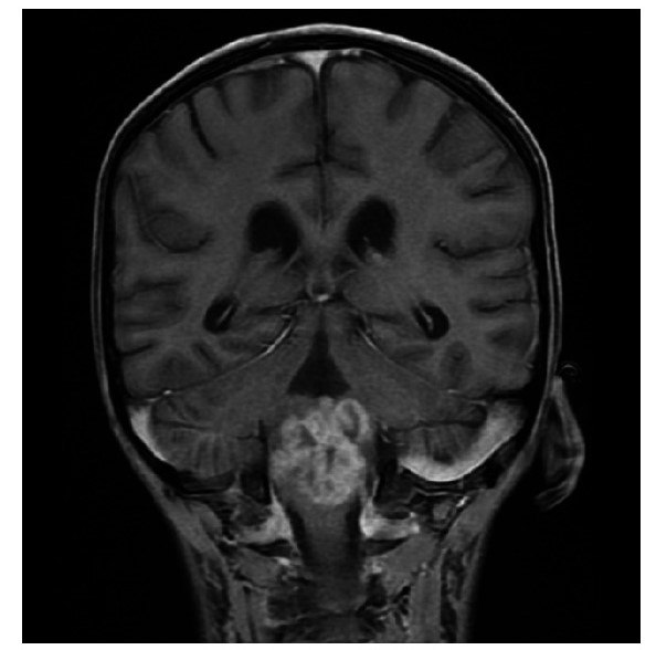 File:Rhaboid tumor gaze evoked nystagmus.jpg