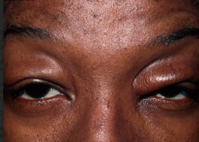 File:Bleph1.png