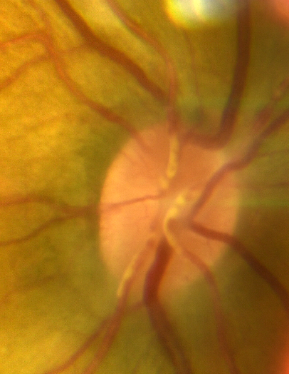 File:Kyrieleis Plaques in central retinal artery .png