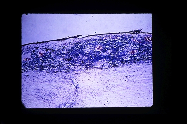 File:Sympathetic Ophthalmia Histology.jpg