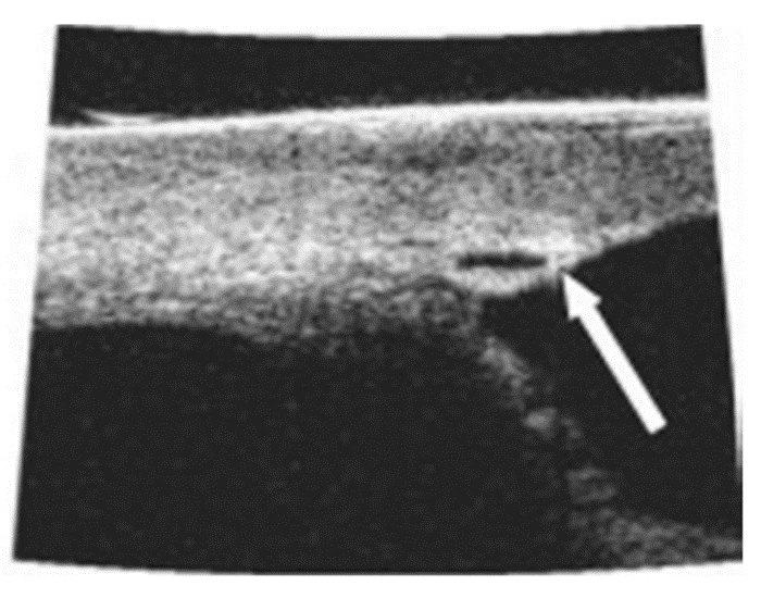 File:UBM of schlemm's canal after canaloplasty.png