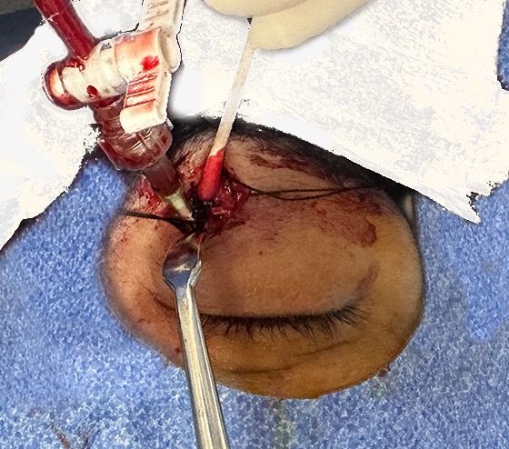 File:Figure 3 SOV cannulated.jpg