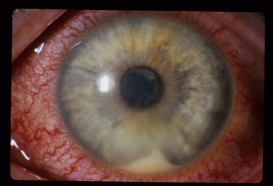 File:Figure 5 Slit Lamp Photo Hypopyon.jpg