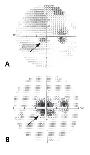 File:MAR VF defect.jpg