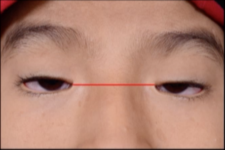 File:Telecanthus in blepharophimosis.png