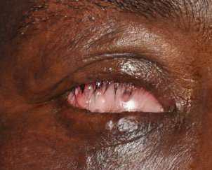 Contracted Socket - EyeWiki