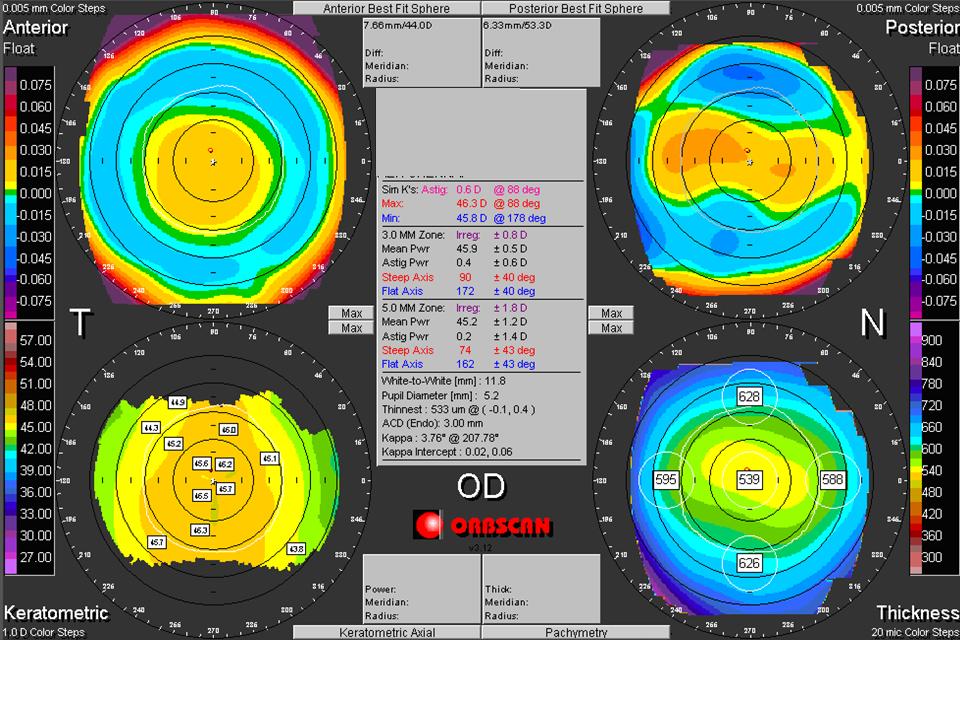 Figure 4 a : Normal Orbscan Quad Map