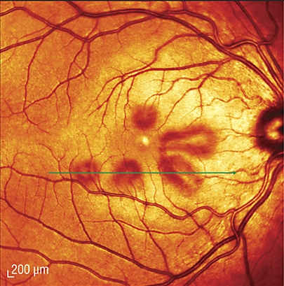 Acute Macular Neuroretinopathy.jpg