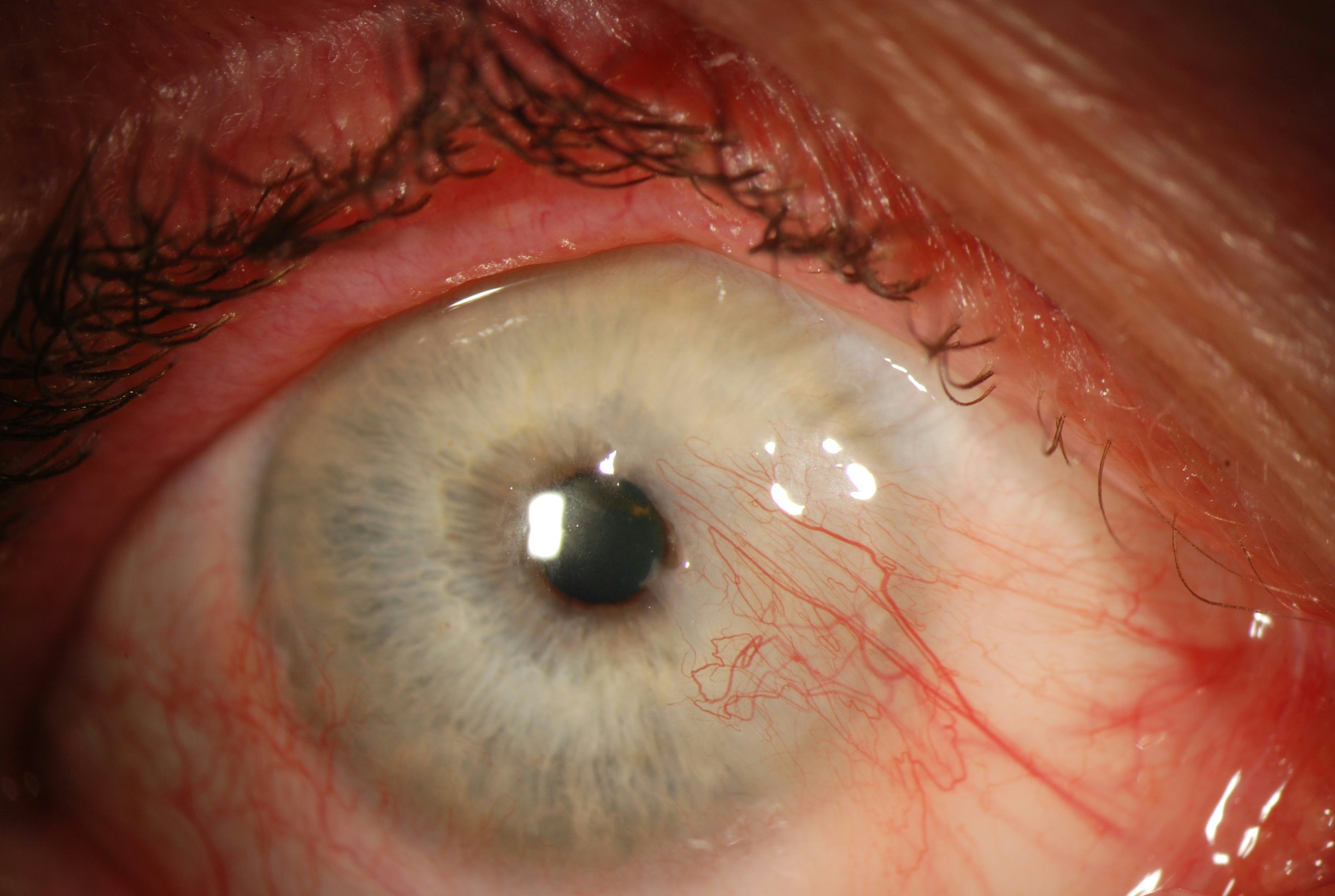 Pterygium