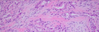Pleomorphic Adenocarcinoma.jpg