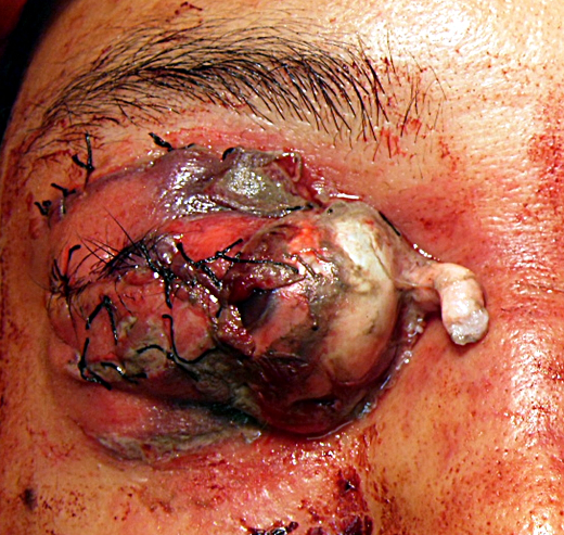 File:Globe luxation 6.png