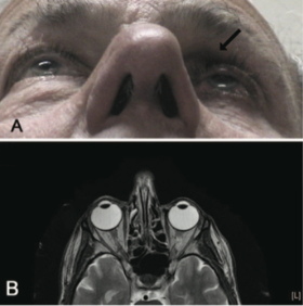 Fig 12: Patient initially presenting for 1 month of intermittent binocular diplopia with history of bimatoprost use in the left eye for 7 months. MRI brain, orbits and MRA head and heck were all performed, which were normal other than apparent enophthalmos and a kinking of the left optic nerve. Courtesy of Filippopoulos et al.