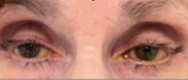 Fig 9: Patient treated for several years with bilateral bimatoprost therapy. Note the bilateral deepened upper lid sulcus and the bilateral mild ptosis.