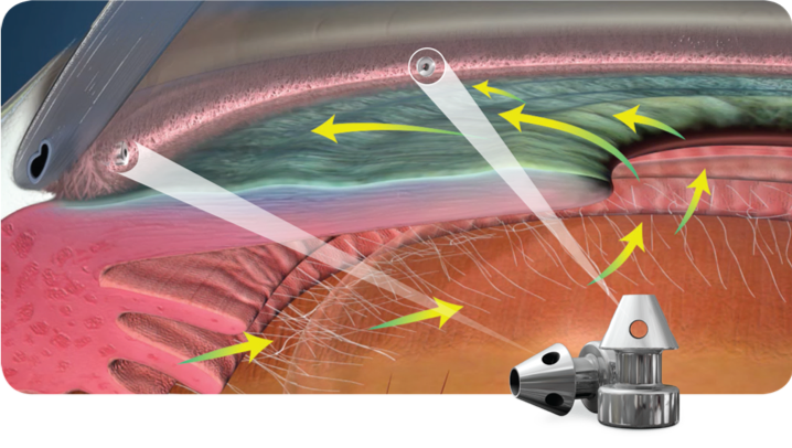File:IStent Aqueous flow.png