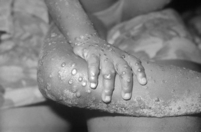 Maculopapular monkeypox lesions