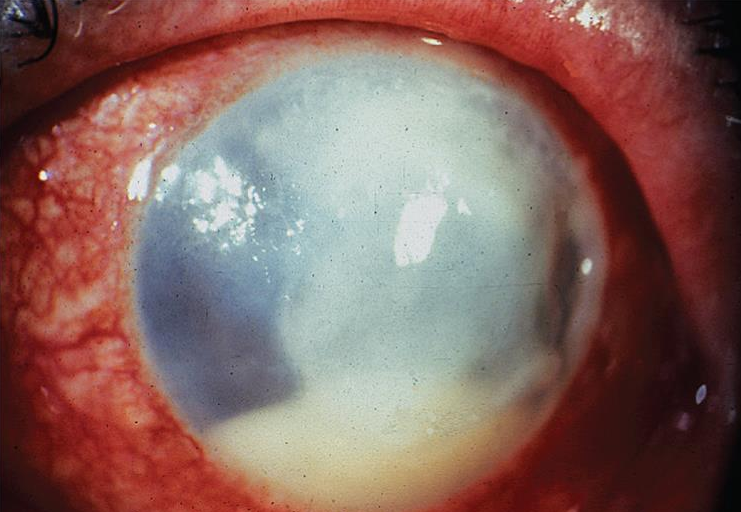 Bacterial keratitis. Bacterial keratitis with stromal infiltrate and hypopyon.