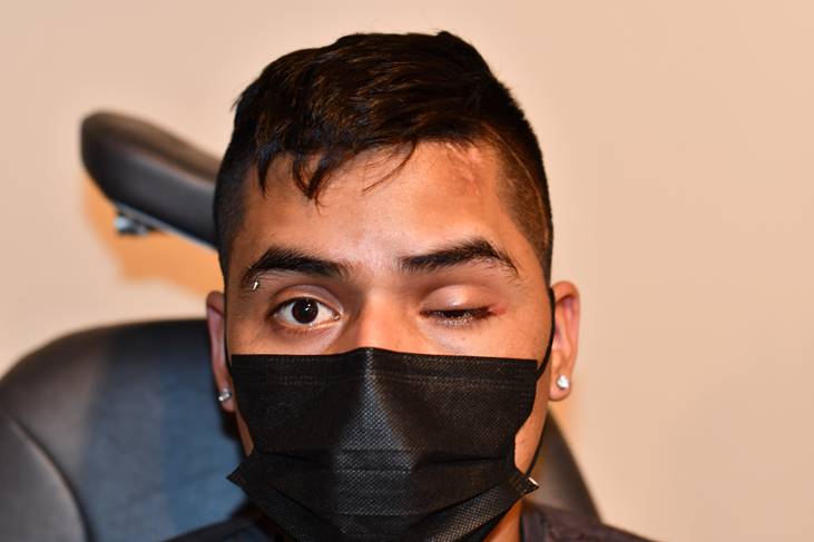 File:Anophthalmic ptosis.jpg