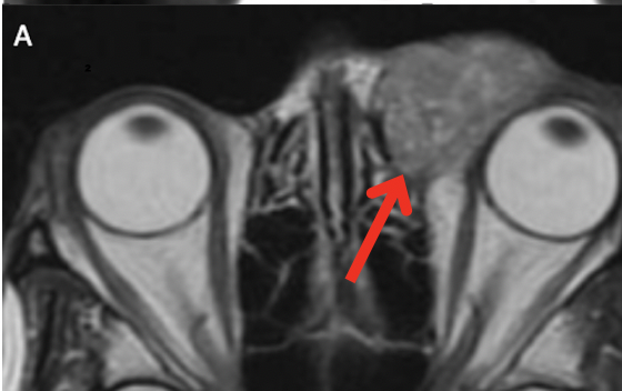 File:Lacrimal Sac tumor MRI Ab.png