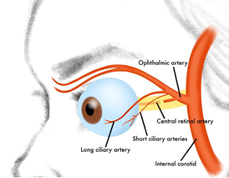 File:Ocular Ischemic Syndrome.png