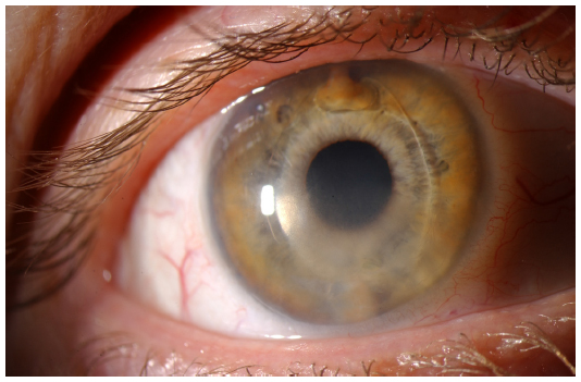 File:Corneal edema.jpg