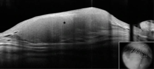 File:Conjunctival RLH - Figure 3.png