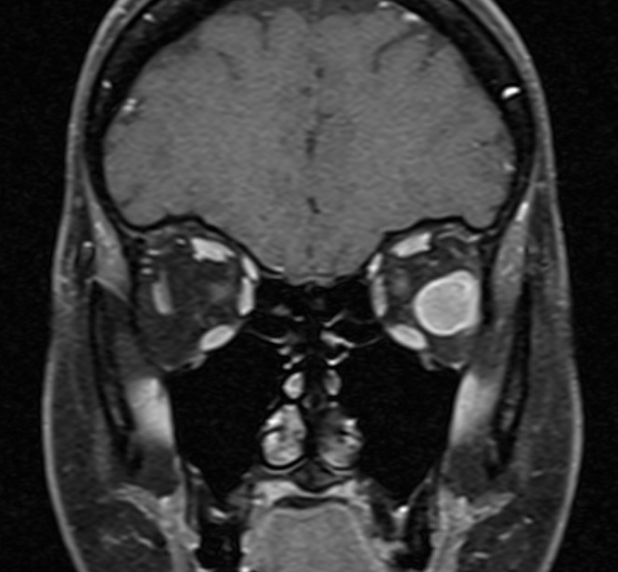 File:GCT MRI Coronal.png