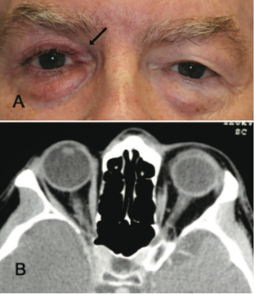 Fig 11: Patient presenting with "fullness of left upper lid" after using bimatoprost in the right eye for 4 years. CT orbits obtained to rule out pathology causing exophthalmos on the left shows a normal left orbit and a more posterior positioned globe on the right. Courtesy of Filippopoulos et al.