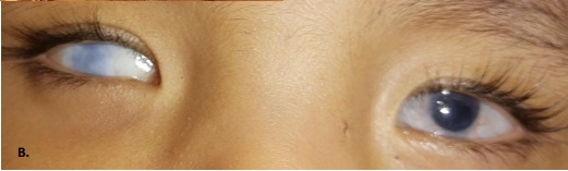 File:Late postoperative penetrating keratoplasty.JPG.jpeg