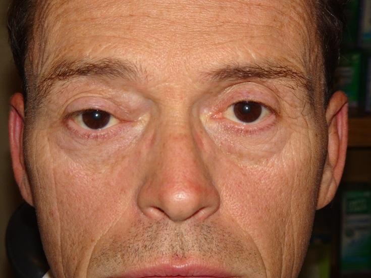 File:SolitaryFibrousTumorImage.jpg