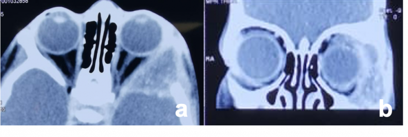 File:Fibrous Dysplasia.png