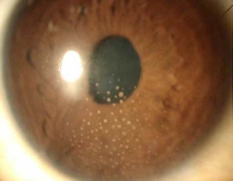 Arlt's Triangle - EyeWiki