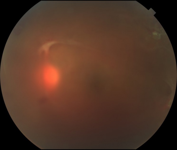 Idiopathic Retinitis, Vasculitis, Aneurysms, and Neuroretinitis (IRVAN ...
