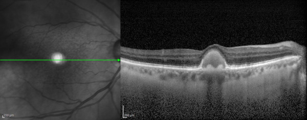 Pattern Dystrophies - EyeWiki
