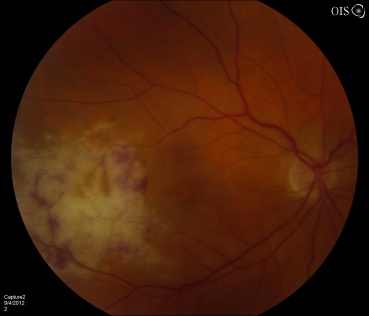CMV Retinitis 3.jpeg