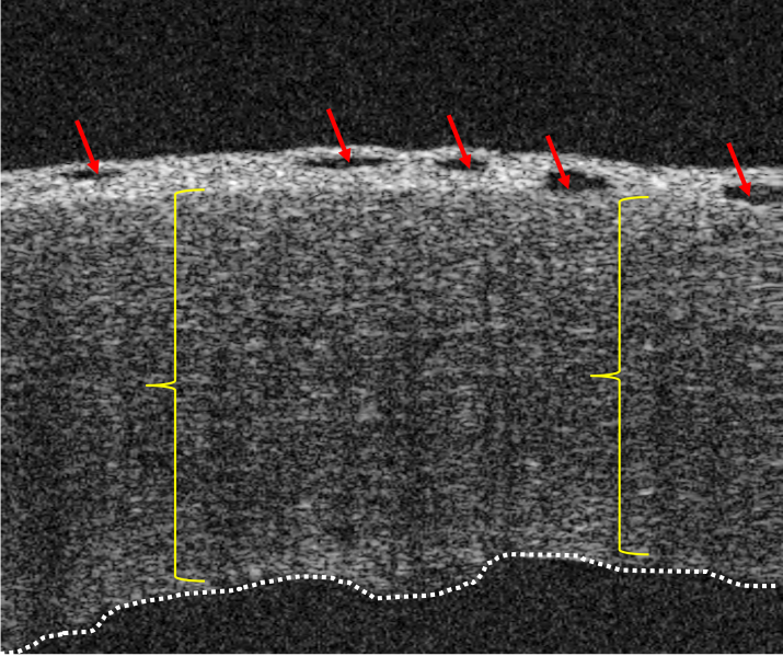File:Pseudophakic bullous keratopathy (PBK).png